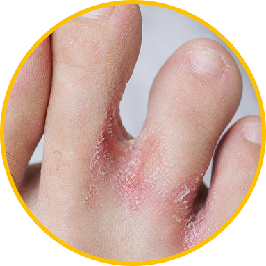 ATHLETE'S FOOT