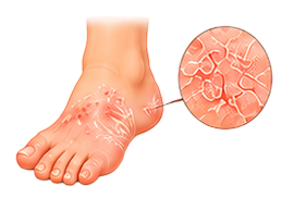 Athlete's Foot