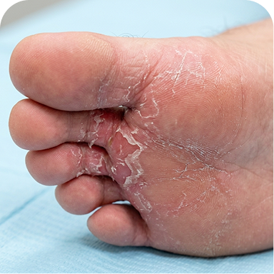 Athlete's Foot