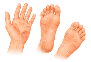 Chapped Hands & Feet