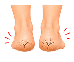 Cracked Heels
