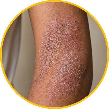 DRY, HARDENED ECZEMA
