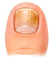 Nail Infection