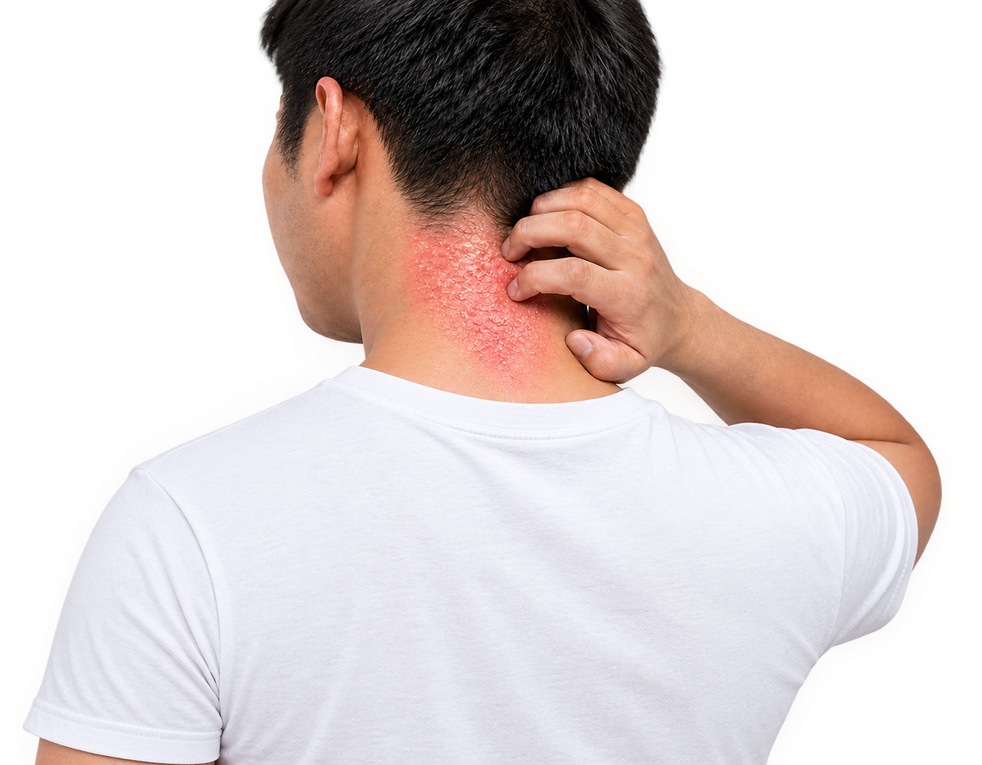 Prickly <span>Heat & Fungal</span> Rash
