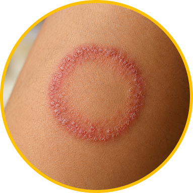 RINGWORM