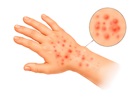 Rashes