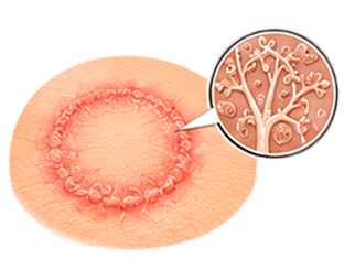 Ringworm