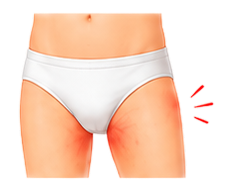 Undergarment Rashes