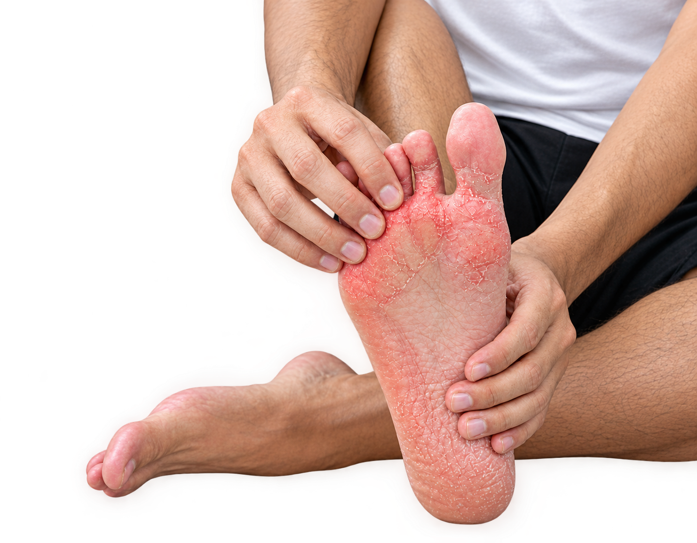 Athlete's Foot  <span>Tinea Pedis</span>